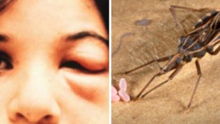 Νόσος του Chagas